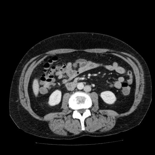 Acute cholecystitis and incidental left sided IVC (Radiopaedia 49352-54459 Axial C+ portal venous phase 80).jpg
