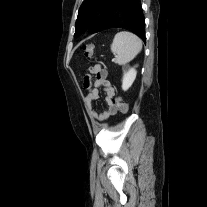 Acute cholecystitis and incidental left sided IVC (Radiopaedia 49352-54459 Sagittal C+ portal venous phase 23).jpg