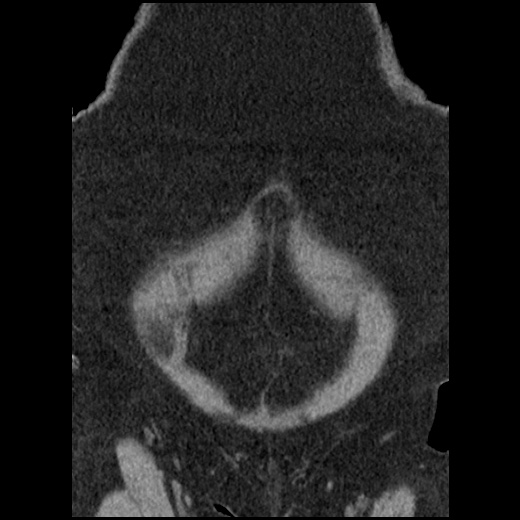 Acute cholecystitis and ureteric colic (Radiopaedia 42330-45444 Coronal prone 19).jpg