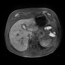 Acute cholecystitis complicated by pylephlebitis (Radiopaedia 65782-74915 Axial T1 fat sat 23).jpg