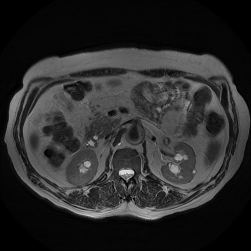 File:Acute cholecystitis complicated by pylephlebitis (Radiopaedia 65782-74915 Axial T2 24).jpg