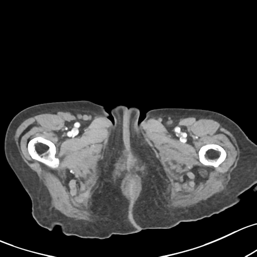 File:Acute cholecystitis with contained perforation (Radiopaedia 47328-51907 Axial C+ portal venous phase 83).png
