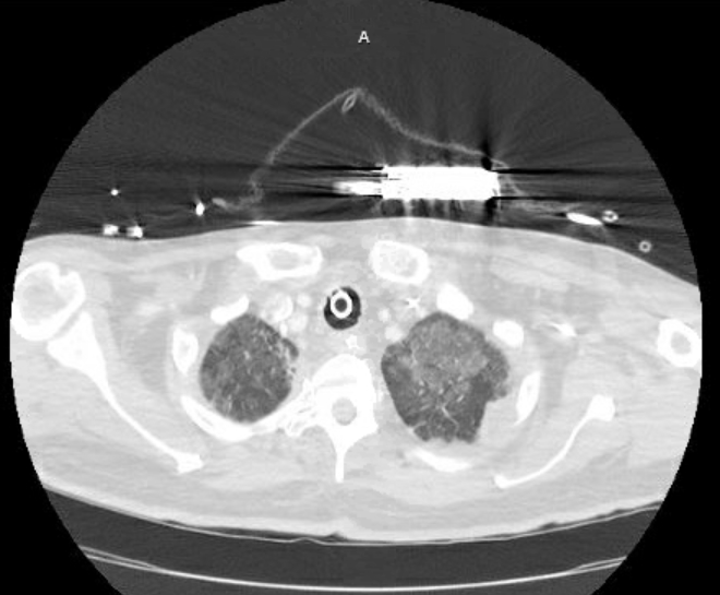 Acute cor pulmonale (ultrasound) (Radiopaedia 83508-98818 Axial lung window 10).jpg