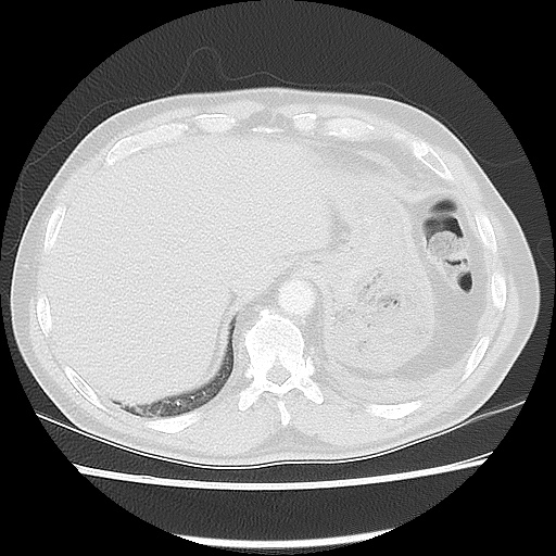 Acute epicardial fat necrosis (Radiopaedia 42327-45440 Axial lung window 49).jpg
