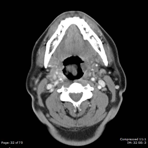 Acute epiglottitis (Radiopaedia 54375-60590 Axial C+ arterial phase 32).jpg