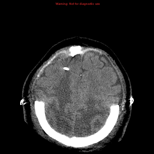 Acute hemorrhagic leukoencephalitis (Radiopaedia 14076-43697 Axial non-contrast 40).jpg