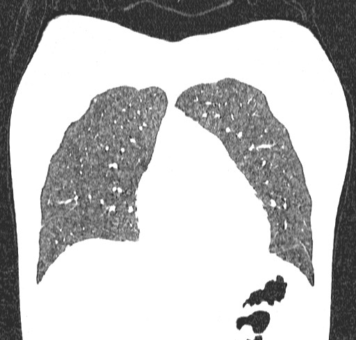 Acute hypersensitivity pneumonitis (Radiopaedia 85293-100870 Coronal lung window 28).jpg