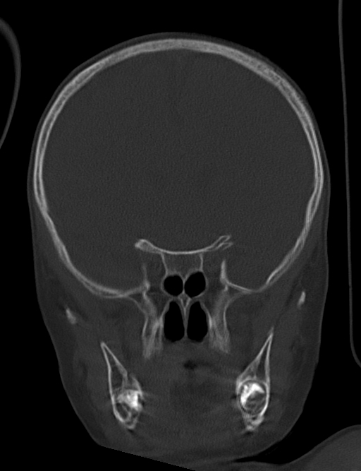 Acute mastoiditis (Radiopaedia 82678-96881 Coronal bone window 26).jpg