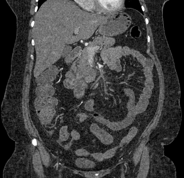 Acute mesenteric ischemia (Radiopaedia 80029-93316 Coronal C+ arterial phase 56).jpg