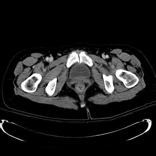 Acute myocardial infarction in CT (Radiopaedia 39947-42415 Axial C+ portal venous phase 137).jpg