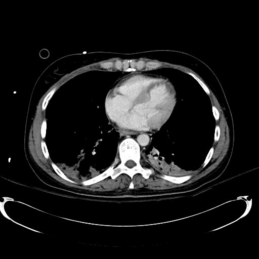 File:Acute myocardial infarction in CT (Radiopaedia 39947-42415 Axial C+ portal venous phase 2).jpg