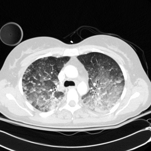 Acute myocardial infarction in CT (Radiopaedia 39947-42415 Axial lung window 40).jpg