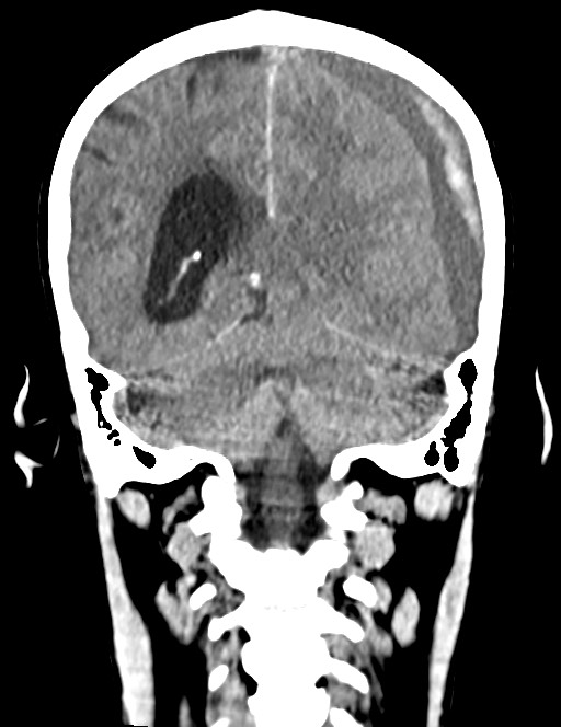 Acute on chronic subdural hematoma (Radiopaedia 74814-85823 Coronal non-contrast 44).jpg