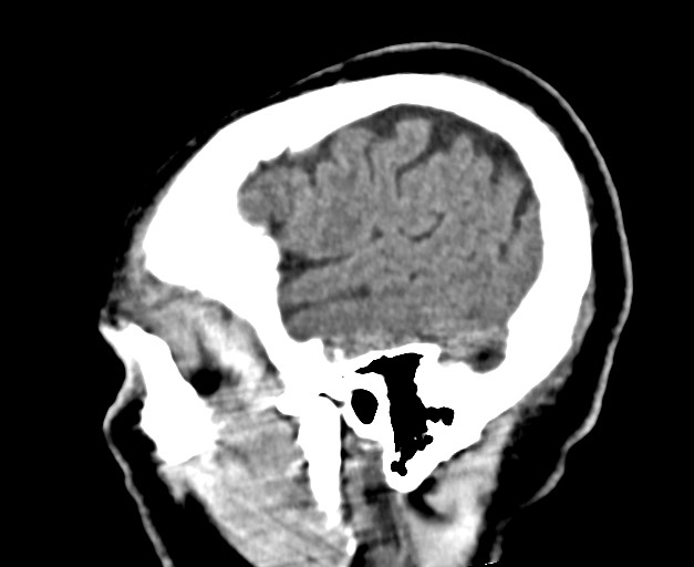 Acute on chronic subdural hematoma (Radiopaedia 78346-90966 Sagittal non-contrast 13).jpg