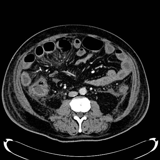 Acute pancreatic necrosis (Radiopaedia 13560-18500 Axial C+ portal venous phase 89).jpg