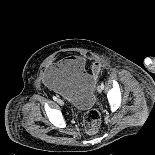 File:Acute pancreatic necrosis (Radiopaedia 13560-18501 Axial C+ portal venous phase 129).jpg