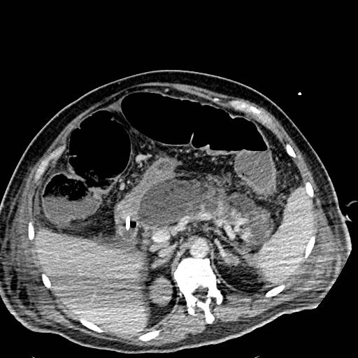 Acute pancreatic necrosis (Radiopaedia 13560-18501 Axial C+ portal venous phase 41).jpg