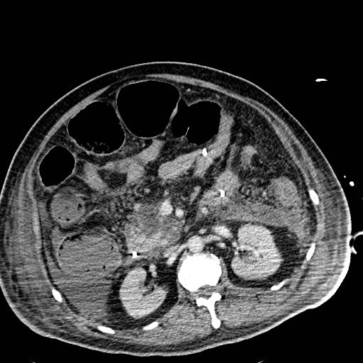 Acute pancreatic necrosis (Radiopaedia 13560-18501 Axial C+ portal venous phase 58).jpg