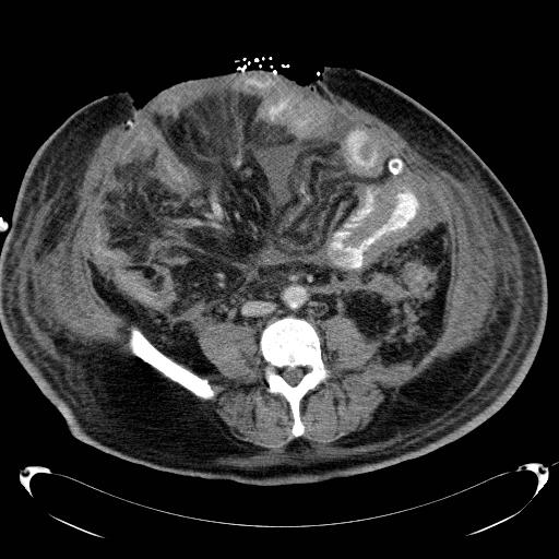 Acute pancreatic necrosis (Radiopaedia 13560-18503 Axial C+ portal venous phase 49).jpg