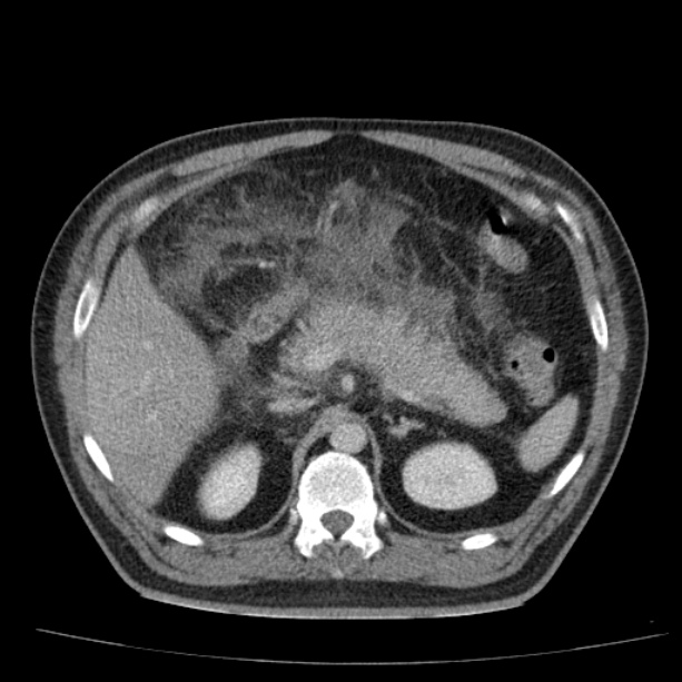 Acute pancreatitis (Radiopaedia 26663-26813 Axial C+ portal venous phase 26).jpg