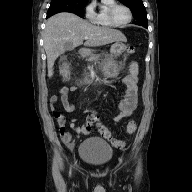 Acute pancreatitis (Radiopaedia 26663-26813 Coronal C+ portal venous phase 24).jpg