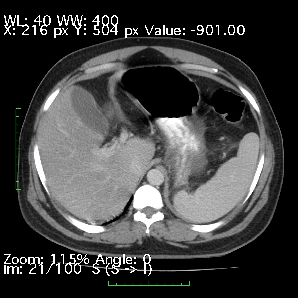 Acute pancreatitis (Radiopaedia 34043-35276 Axial C+ portal venous phase 21).jpg