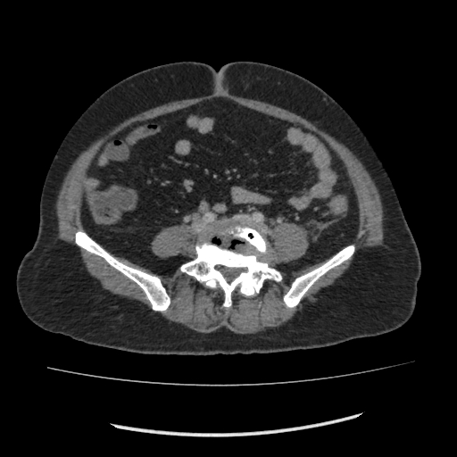 Acute pancreatitis (Radiopaedia 80007-93285 Axial C+ portal venous phase 113).jpg