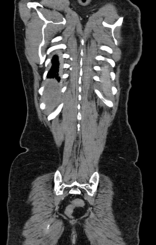 Acute pancreatitis (Radiopaedia 80007-93285 Coronal C+ portal venous phase 135).jpg