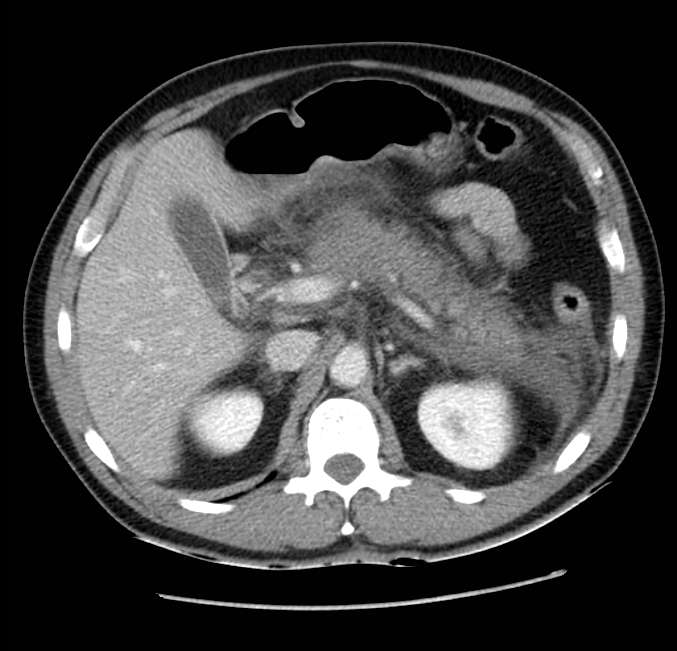 Acute pancreatitis - Balthazar E (Radiopaedia 23080-23110 Axial C+ portal venous phase 21).jpg