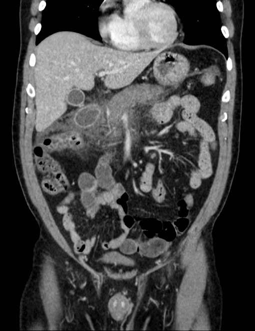 Acute pancreatitis - Balthazar E (Radiopaedia 23080-23110 Coronal C+ portal venous phase 27).jpg