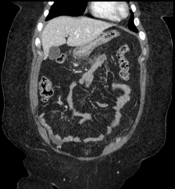 Acute pancreatitis - Balthazar E (Radiopaedia 29016-29377 Coronal C+ portal venous phase 31).png