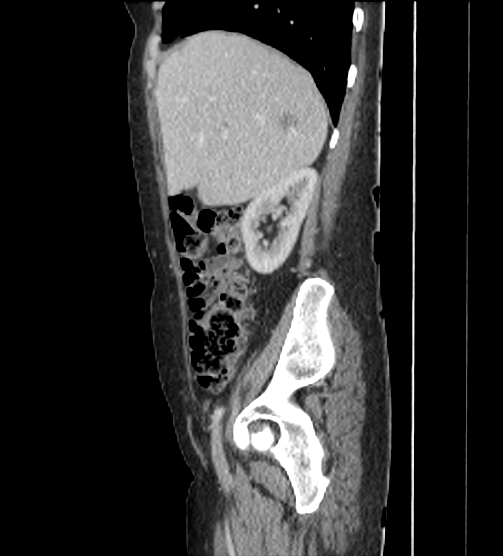 File:Acute pancreatitis - Balthazar E - post ERCP (Radiopaedia 27562-27772 Sagittal C+ portal venous phase 30).png