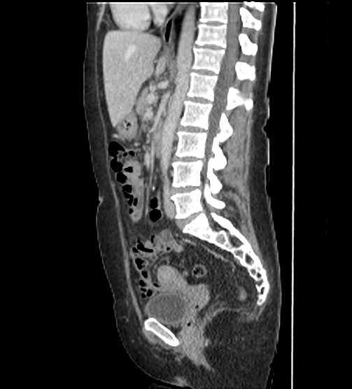 File:Acute pancreatitis - Balthazar E - post ERCP (Radiopaedia 27562-27772 Sagittal C+ portal venous phase 71).png
