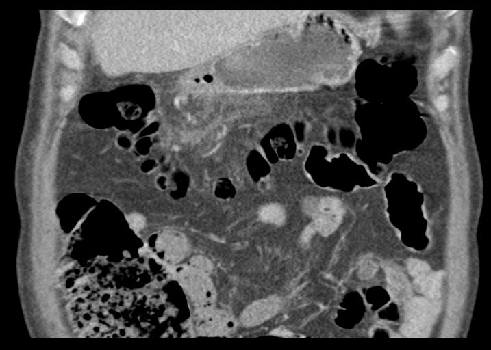 Acute pancreatitis and walled-off necrosis (Radiopaedia 29888-30403 Coronal C+ portal venous phase 17).jpg