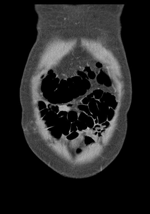 Acute pancreatitis and walled-off necrosis (Radiopaedia 29888-30403 E 9).jpg