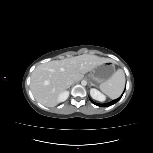 Acute pancreatitis secondary to stone at minor papilla and pancreatic divisum (Radiopaedia 76570-88333 Axial C+ portal venous phase 16).jpg
