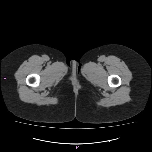 Acute pancreatitis secondary to stone at minor papilla and pancreatic divisum (Radiopaedia 76570-88333 Axial non-contrast 90).jpg