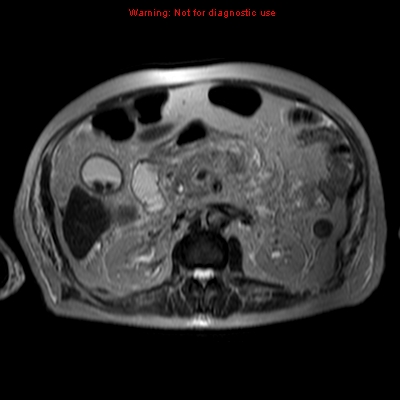 File:Acute pancreatitis with incidental pancreatic lipoma (Radiopaedia 10190-10732 Axial T2 7).jpg