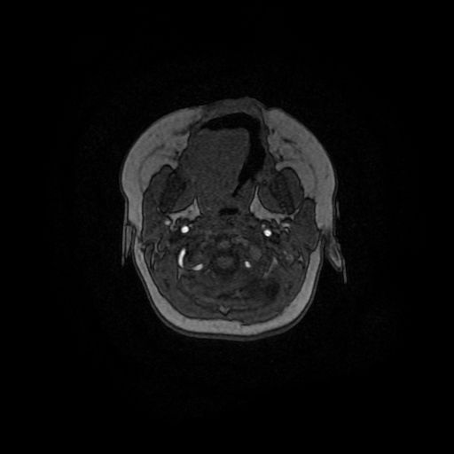Acute phase of hemiconvulsion-hemiplegia epilepsy syndrome (Radiopaedia 29309-29745 Axial TOF angiography 161).jpg