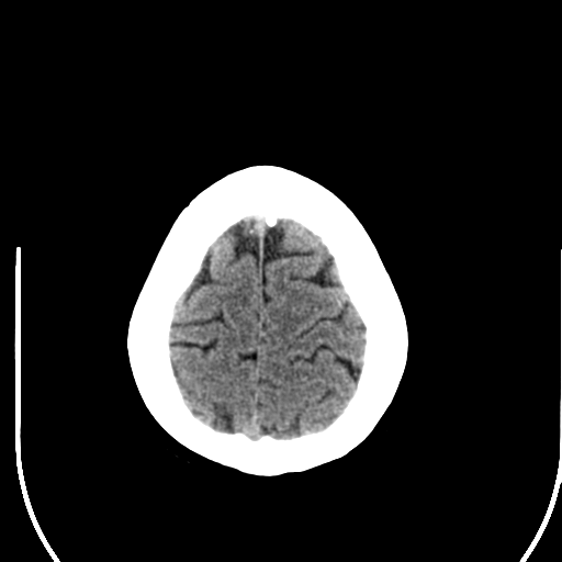 File:Acute pontine infarct from vertebral artery dissection (Radiopaedia 34111-35369 Axial non-contrast 27).png