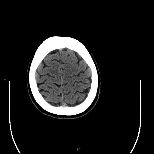 File:Acute posterior cerebral artery territory infarct (Radiopaedia 79329-92393 Axial non-contrast 96).jpg