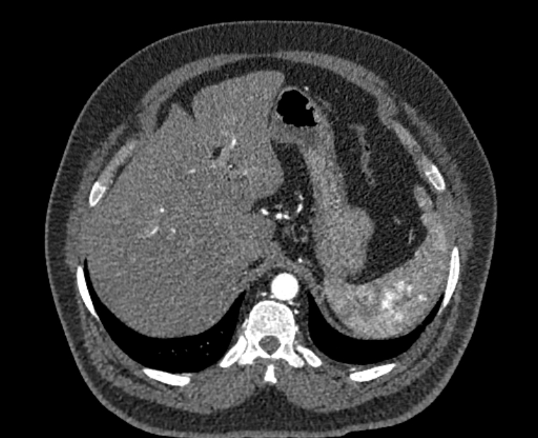 Acute pulmonary embolism with pulmonary infarcts (Radiopaedia 77688-89908 Axial C+ CTPA 67).jpg