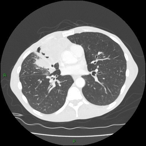 Acute right lung abscess (Radiopaedia 34806-36258 Axial lung window 105).jpg