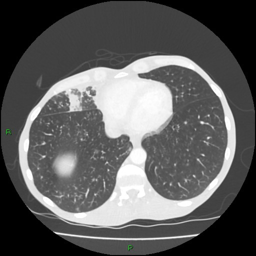 File:Acute right lung abscess (Radiopaedia 34806-36258 Axial lung window 144).jpg