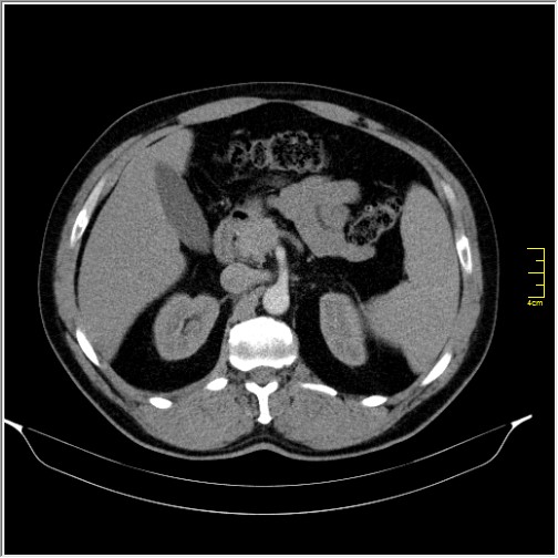 Acute right sided diverticulitis (Radiopaedia 65249-74268 Axial C+ portal venous phase 24).JPG