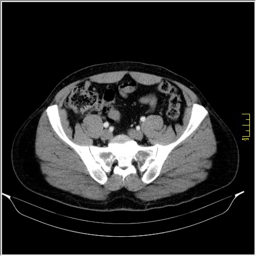 File:Acute right sided diverticulitis (Radiopaedia 65249-74268 Axial C+ portal venous phase 60).JPG