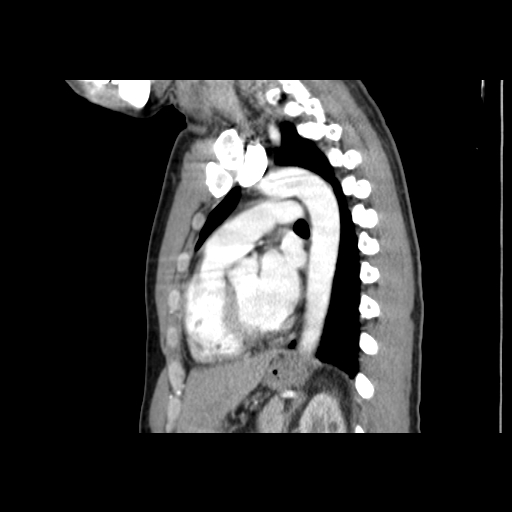 File:Acute segmental pulmonary emboli and pulmonary infarction (Radiopaedia 62264-70444 Sagittal C+ CTPA 41).jpg