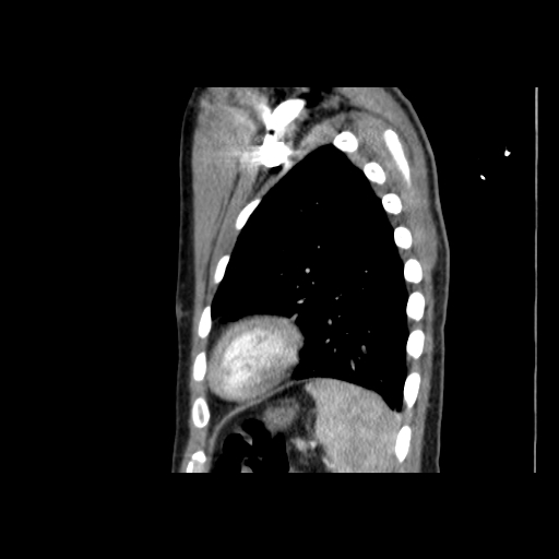 Acute segmental pulmonary emboli and pulmonary infarction (Radiopaedia 62264-70444 Sagittal C+ CTPA 52).jpg