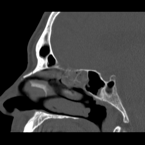 Acute sinusitis (Radiopaedia 23161-23215 Sagittal bone window 31).jpg