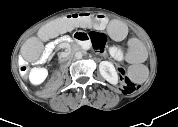 File:Acute small bowel (ileal) volvulus (Radiopaedia 71740-82139 Axial C+ portal venous phase 99).jpg